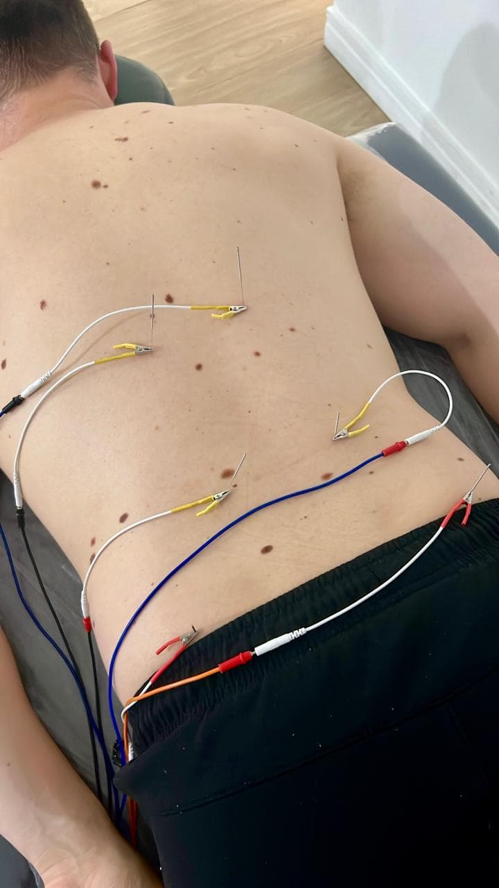 Dry Needling